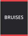 BRUISES